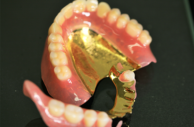 入れ歯（義歯）で手に入れる噛む機能と歯のある口元