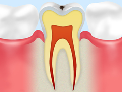 C0　脱灰（初期虫歯）