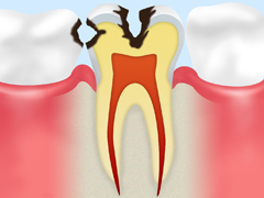 C2　象牙質の虫歯