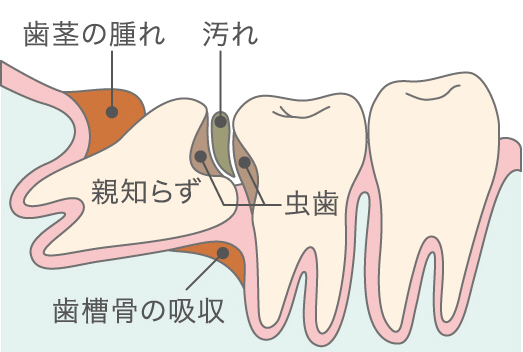 親知らずについて